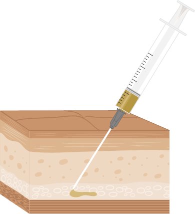 Ilustração de intradermoterapia